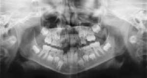 Children's Dentist - Dental Radiographs (X-Rays)