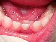 Baby Teeth - Children's Dentistry